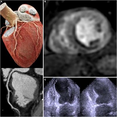 The chronic coronary syndrome—Heart failure roundabout: A multimodality imaging workflow approach